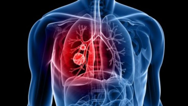  A prevenção é a melhor forma de lutar contra o câncer de pulmão