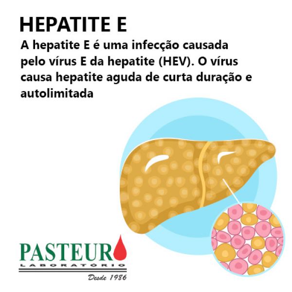  Hepatite E