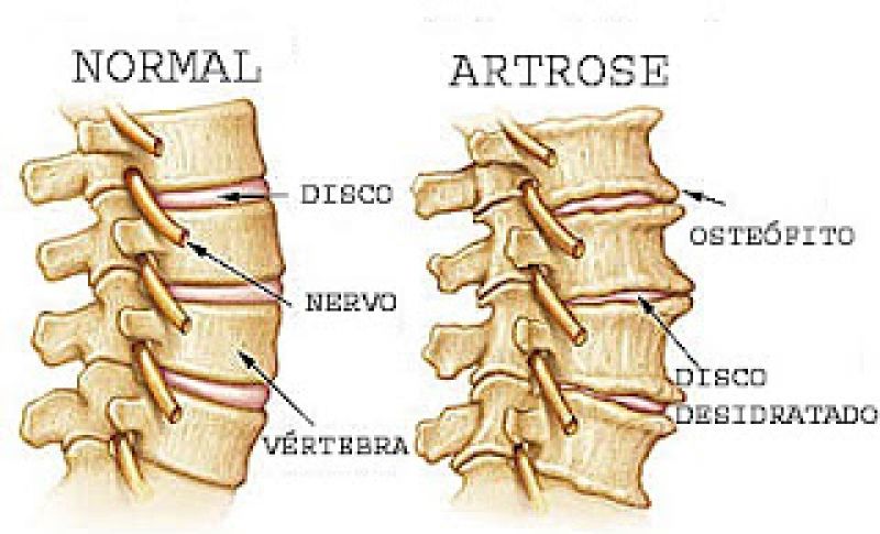 Osteoartrite/ Artrose