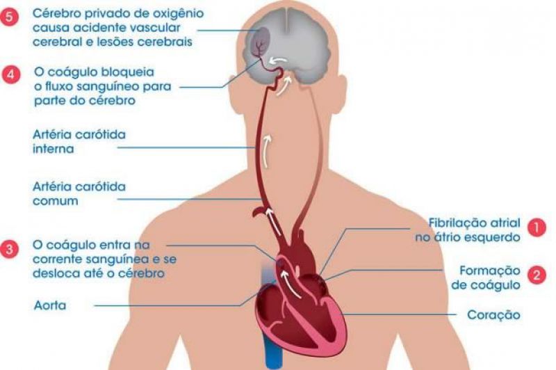 O acidente vascular cerebral (AVC) ou derrame