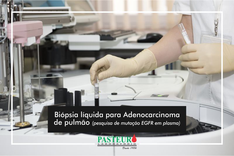  Biópsia líquida para Adenocarcinoma de pulmão (pesquisa de mutação EGFR em plasma)