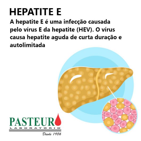 Hepatite E